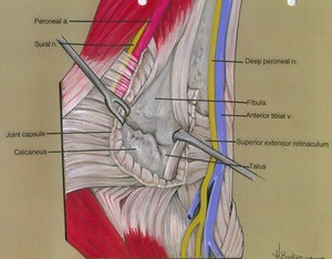 Illustration of dissection of the dorsal surface of the foot and ankle, showing the related musculature and vasculature; the extensor retinaculum has been cut and reflected to expose the joint capsule