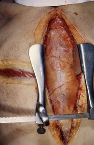 Natural color photograph of dissection of the thorax, anterior view, with the skin and divided sternum retracted to expose the parietal pleura overlying the cardiac region