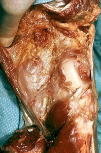 Natural color photograph of dissection of the right knee, posterior view, with the skin removed to expose the politeal fossa and articular surface of the lateral condyle of the femur