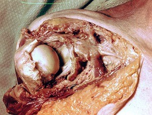 Natural color photograph of dissection of the right shoulder, anterosuperior view, showing the glenohumeral joint capsule and bone structure of the shoulder