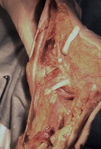 Natural color photograph of dissection of the right ankle, medial view, with the tibialis posterior tendon and flexor digitorum longus tendon cut