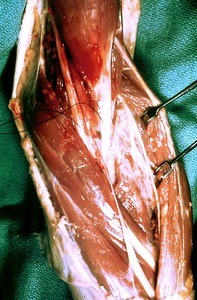 Natural color photograph of dissection of the left cubital fossa, anteromedial view