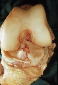 Natural color photograph of dissection of the left knee, disarticulated, showing bones and ligaments