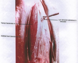 Natural color photograph of right hip, lateral view, showing muscle, nerve and ligament