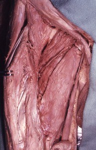 Natural color photograph of dissection of the right femoral triangle, with the femoral vessels cut and removed