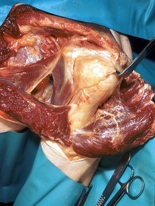 Natural color photograph of dissection of the left shoulder, anterior view, with the deltoid muscle reflected to expose the axillary nerve and the capsule of the glenohumeral joint retracted to expose the head of the humerus
