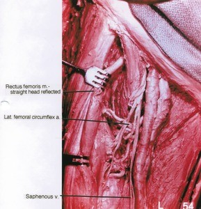 Natural color photograph of dissection of the femoral triangle, showing the femoral artery branches