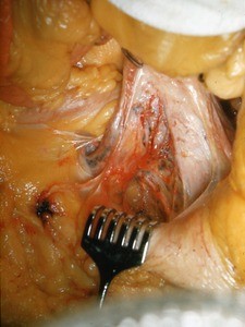 Natural color photograph of dissection of the abdomen, anterior view