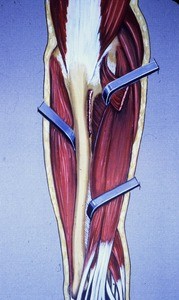 Illustration of dissected left forearm & distal arm, posterior aspect, in supination, emphasizing forearm muscles and their tendons in relation to the ulna and especially at the wrist