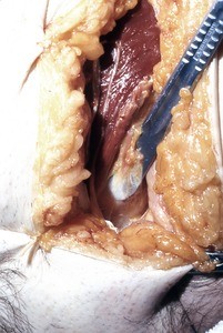 Natural color photograph of dissection of the left inguinal region, anterior view