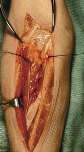 Natural color photograph of dissection of the forearm, anterior view