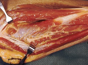 Natural color photograph of dissection of the forearm