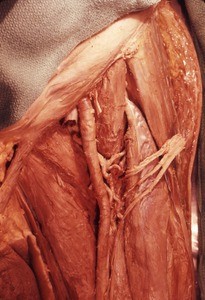 Natural color photograph of dissection of the left thigh, anterior view, showing the femoral artery and its branches, with the femoral vein removed and the femoral nerve cut and reflected laterally