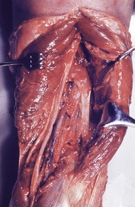 Natural color photograph of dissection of the cubital fossa, anterior view