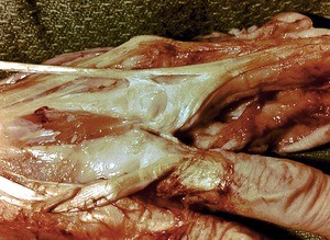 Natural color photograph of dissection of the dorsal surface of the right hand