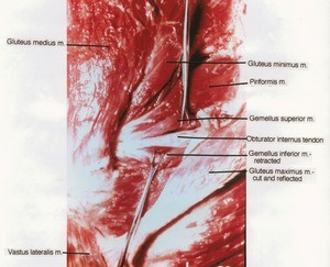 Natural color photograph of dissection of the left gluteal region, posterior view