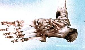 Illustration of skeleton of right foot from plantar surface showing the long plantar ligament and plantar calcaneonavicular ligament (spring ligament) plus tibiotalar joint (fibula absent)