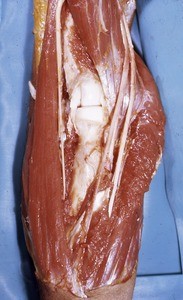 Natural color photograph of dissection of the right cubital fossa, anterior view, with the head of the radius articulating with the lateral epicondyle of the humerus