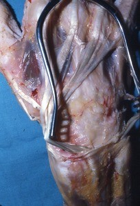 Natural color photograph of dissection of the dorsal surface of the right hand, with the extensor retinaculum retracted