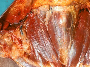 Natural color photograph of dissection of the neck, anterior view, showing the thyroid cartilage and the sternocleidomastoid and the sternohyoid muscles