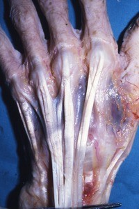 Natural color photograph of dissection of the dorsal surface of the left hand