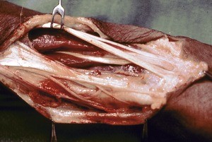 Natural color photograph of dissection of the forearm, anterior view