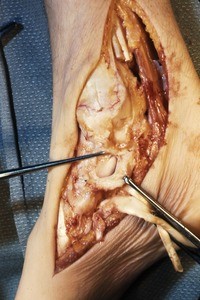 Natural color photograph of dissection of the right ankle, medial view, exposing the articular surface between the talus and the sustentaculum tali