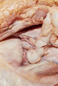 Natural color photograph of dissection of the lower abdominal and pelvic cavity, anterior view, showing the bladder, fundus of the uterus, and sigmoid colon