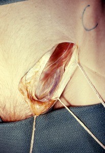 Natural color photograph of dissection of the inguinal region, anterior view, showing inguinal vessels