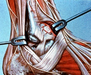 Illustration of surgical exposure of right lateral malleolar region, flexor retinaculum cut