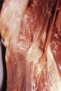 Natural color photograph of dissection of the left popliteal fossa, emphasizing the common fibular nerve as it courses inferior to the fibular head