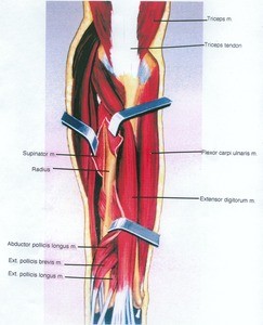 Illustration of dissection of the left elbow and forearm, posterior view, emphasizing the extensor musculature with the supinator muscle cut and retracted