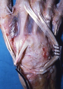 Natural color photograph of dissection of the dorsal surface of the right hand, with the extensor tendons retracted