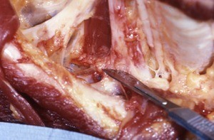 Natural color photograph of dissection of the right side of the neck, anterior view, showing muscles, nerves, and vessels