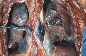 Natural color photograph of dissection of the thorax, anterior view, with the rib cage removed to expose a penetrating wound in the mediastinum