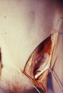 Natural color photograph of dissection of the left inguinal region, anterior view, with the inguinal ligament tied and retracted