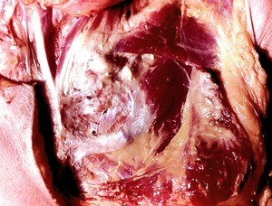 Natural color photograph of dissection of the thoracic wall, anterior view, showing the left clavicle and left pectoralis major m., which has been partially removed to expose the 2nd rib