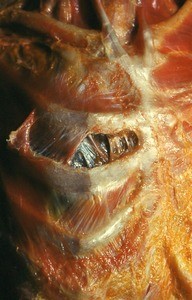 Natural color photograph of dissection of the thorax, anterior view, skin and superficial muscle layers removed to expose the clavicle, ribs 1-4, and tendons of the sternocleidomastoid muscles