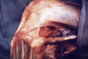 Natural color photograph of dissection of the left knee, lateral view