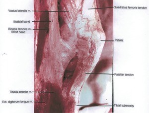 Natural color photograph of right knee, latero-anterior view, showing bones and muscles