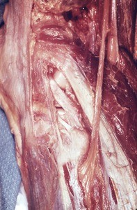 Natural color photograph of dissection of the popliteal fossa, showing the common fibular nerve as it courses anteriorly, inerior to the fibular head