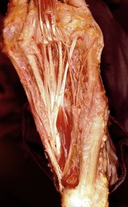 Natural color photograph of dissection of the plantar surface of the left foot