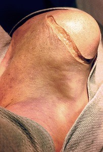 Natural color photograph of dissection of the right shoulder, superior view, with an incision in the skin over the shoulder