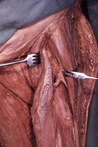 Natural color photograph of dissection of the left femoral triangle