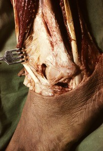 Natural color photograph of dissection of the left ankle, lateral view, exposing the fibula and related structures