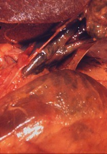 Natural color photograph of dissection of the portal circulation, anterior view