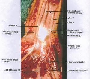 Natural color photograph of dissection of right wrist, anterior view, showing tendons, nerves and artery