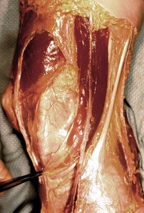 Natural color photograph of the right knee, medial view, with the skin removed to expose the fascial layers, muscle structure, and nerves of the knee