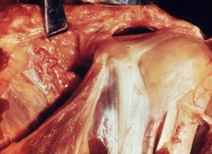 Natural color photograph of dissection of the left shoulder, anterior view, with the clavicle retracted to reveal the tendons and ligaments of the anterior shoulder