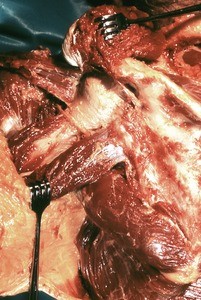 Natural color photograph of dissection of the left shoulder, posterior view, showing the posterior muscles of the shoulder